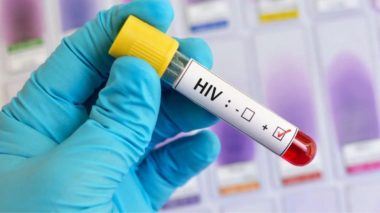 HIV FOTO